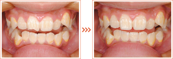 小児歯科の症例